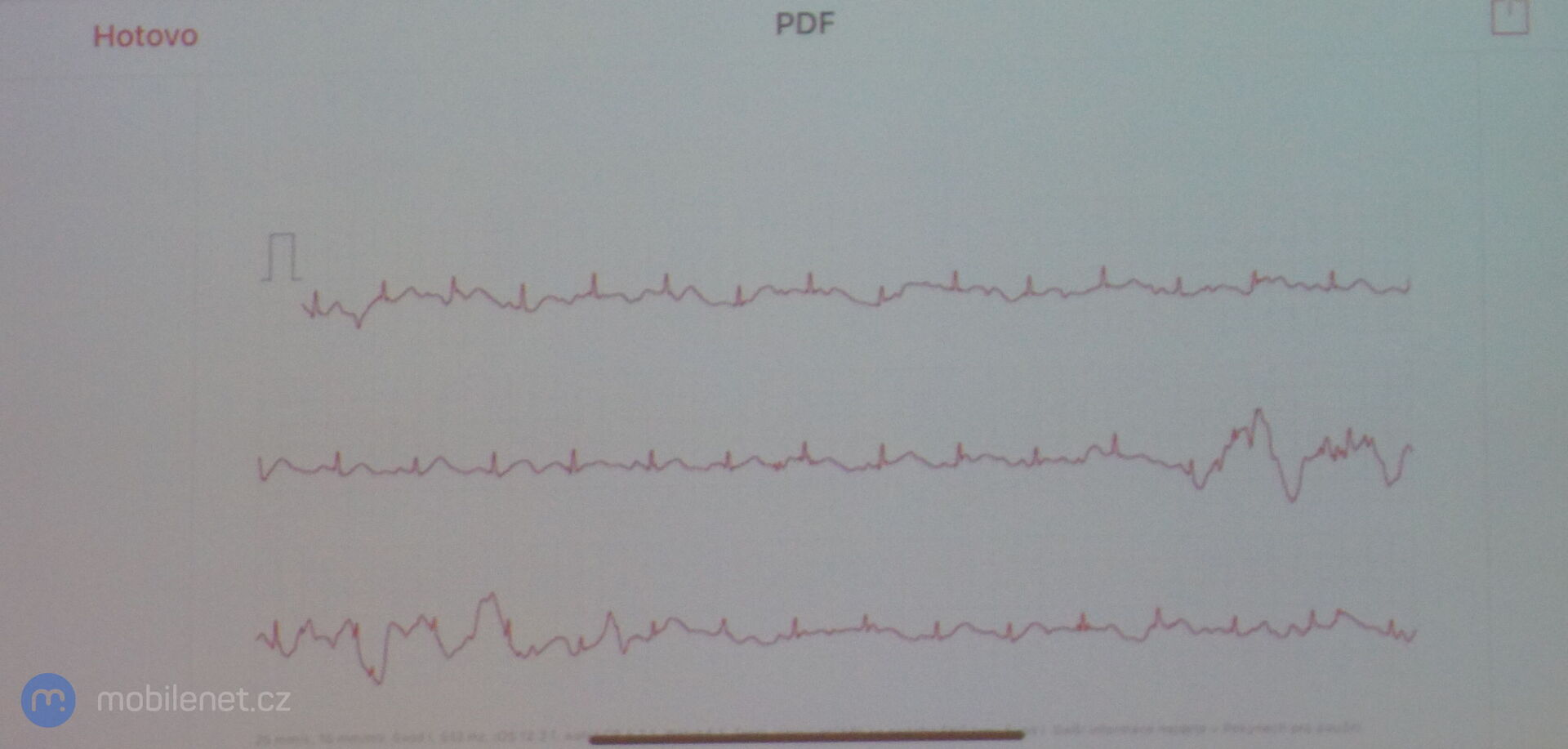 EKG