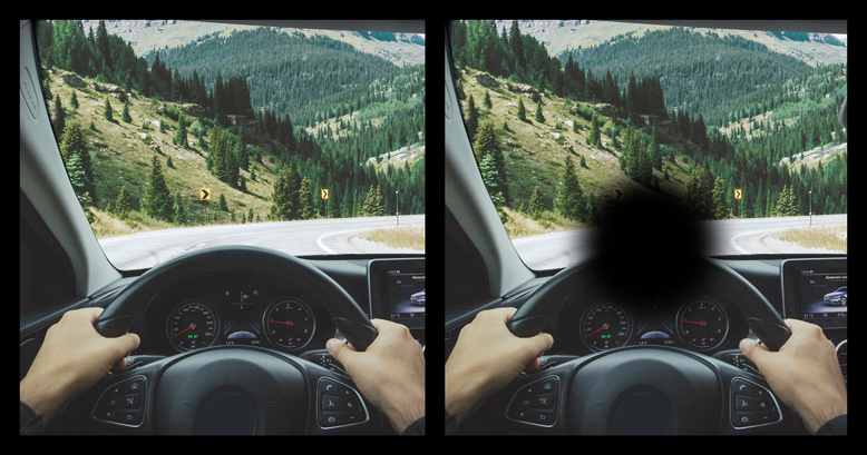 Věkem podmíněná makulární degenerace