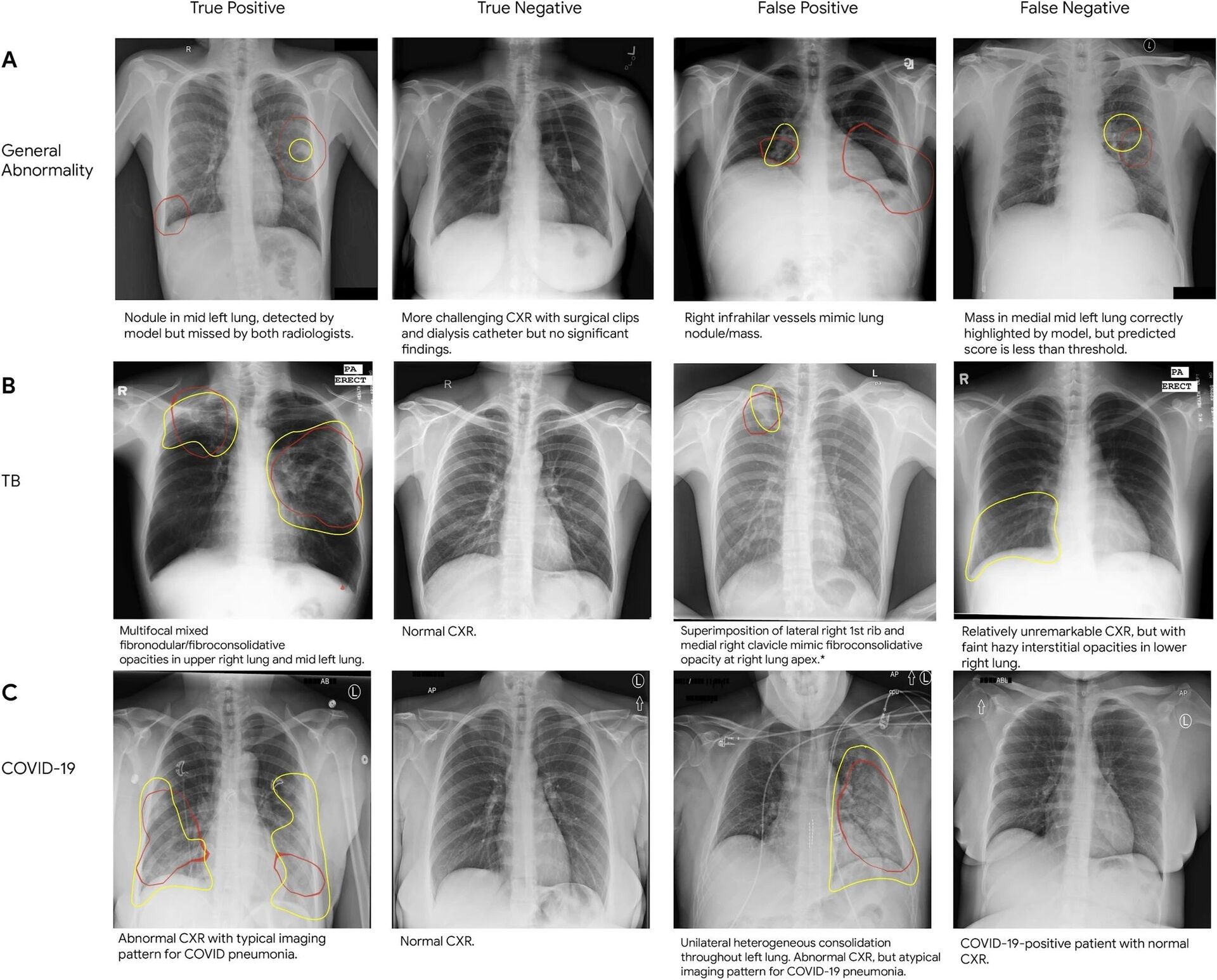 CXR AI