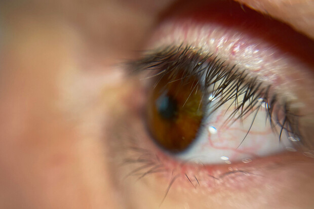 První pacient dostal náhradu oka vytištěnou na 3D tiskárně