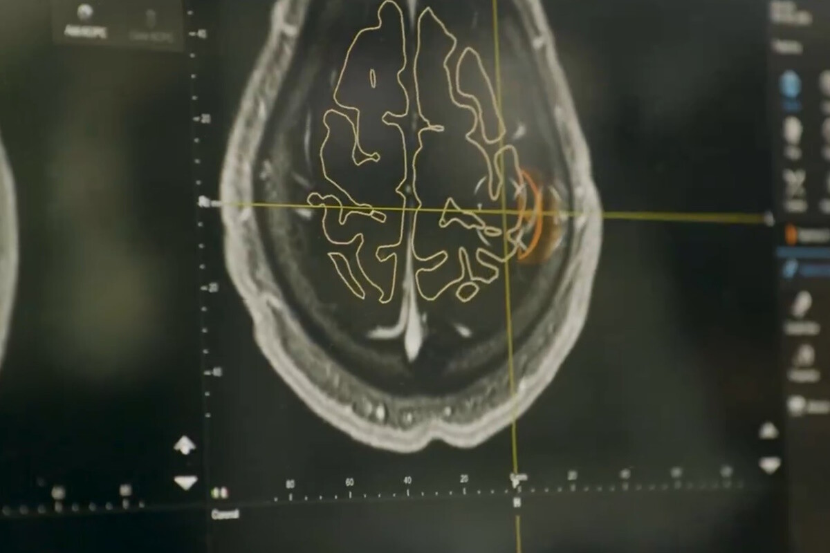 Implantace Neuralinku je schválena pro pacienta č. 2. Firma chce jít ...