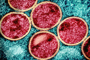 Do Evropy se dostala nová varianta mpox. Nakažení pobývali předtím v Africe