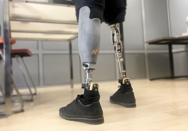 Protéza vyrobená na 3D tiskárně
